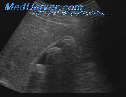 рак фатерова сосочка