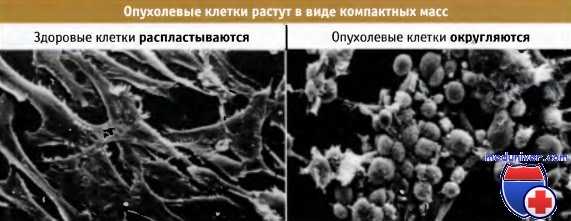 Рост раковых клеток