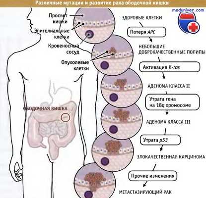 Мутации и развитие рака ободочной кишки