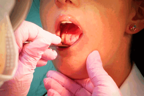 Рак миндалин