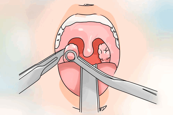 Лечение рака миндалин