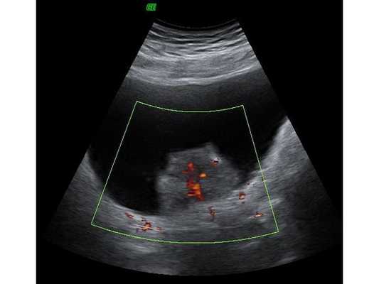 Снимок УЗИ от 15 октября 2021 года