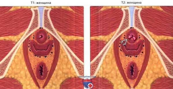 Стадии рака уретры