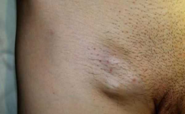 Увеличенные паховые узлы