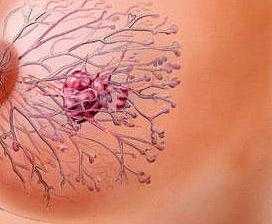 Рак молочной железы у беременных