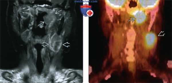 КТ, МРТ при раке носоглотки