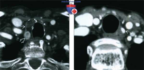 КТ, МРТ, УЗИ при аденоме паращитовидной железы в висцеральном пространстве