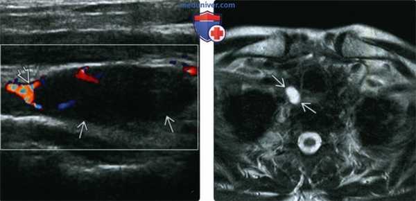 КТ, МРТ, УЗИ при аденоме паращитовидной железы в висцеральном пространстве