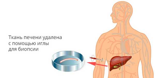 Пункционная биопсия печени