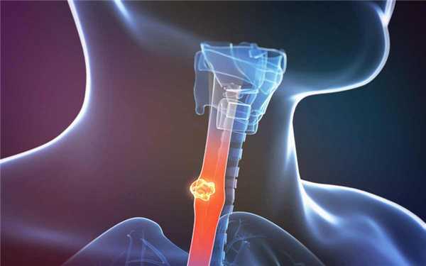 Рак пищевода