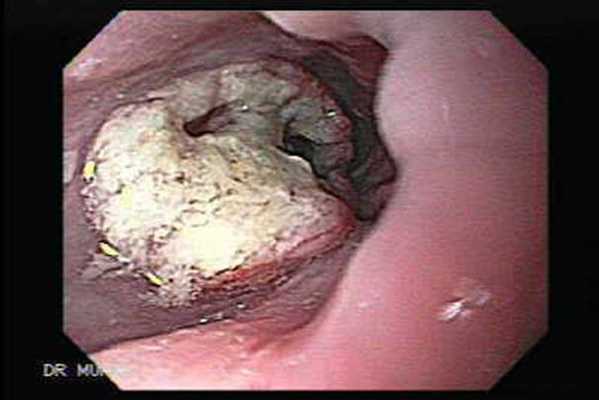 Эндоскопическая картина плоскоклеточного рака