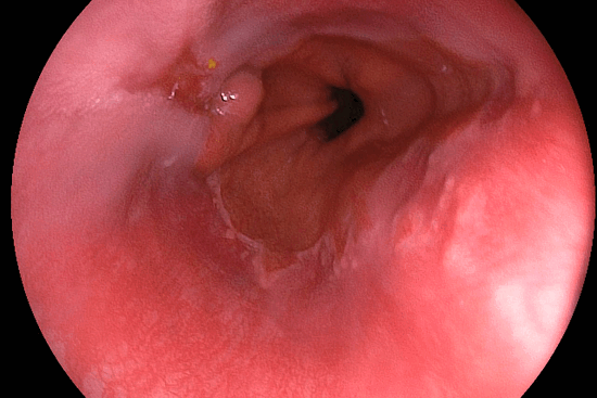 Первая стадия рака пищевода: симптомы и признаки