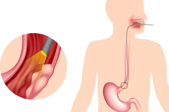 Первая стадия рака пищевода: симптомы и признаки