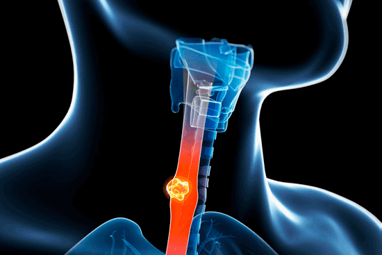 Рак пищевода