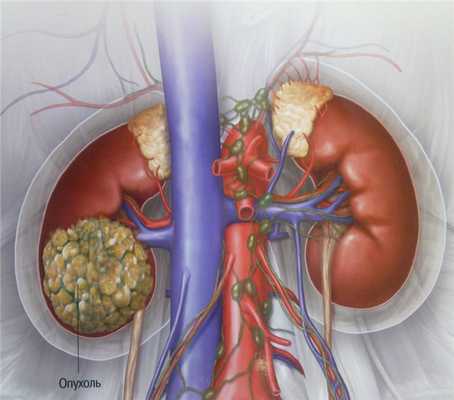 Рак почек 1 стадии