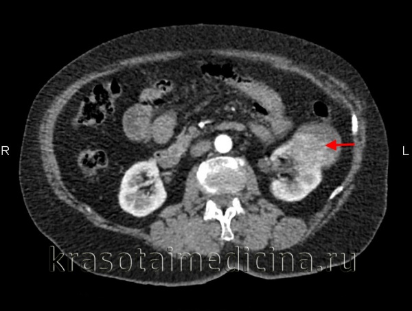 КТ ОБП и забрюшинного пространства. Злокачественная опухоль левой почки.