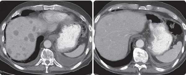 поджелудочная метастазы