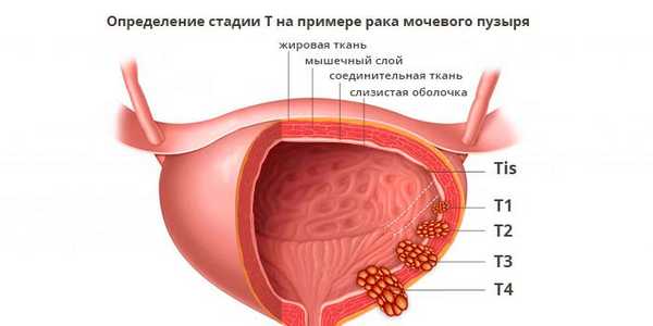 rak-mochevogo-puzyrya
