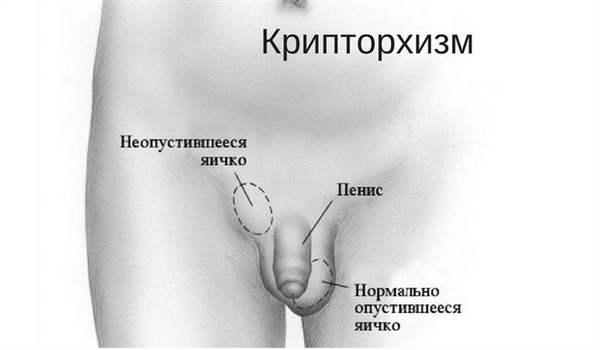 Крипторхизм