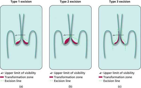 Эксцизия при дисплазии шейки матки