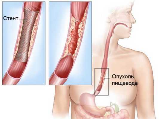 Стентирование рака пищевода