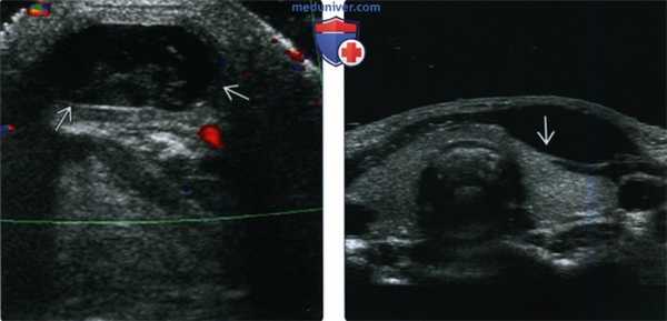 КТ, МРТ при кисте щитоязычного протока