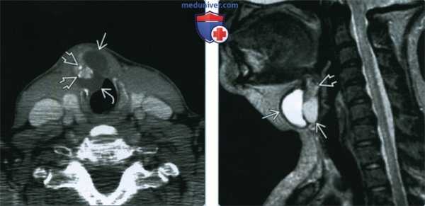 Рак щитоязычного протока - лучевая диагностика