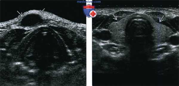 КТ, МРТ при кисте щитоязычного протока