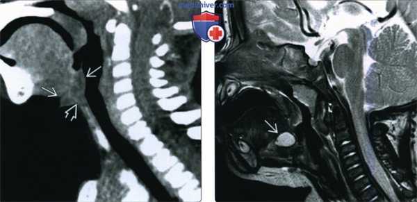 КТ, МРТ при кисте щитоязычного протока