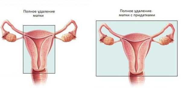 Варианты операций при саркоме матки