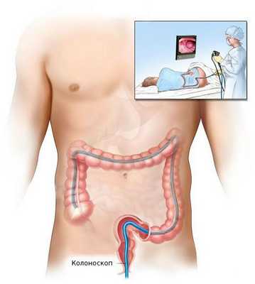 Колоноскопия