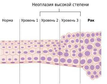 Вульварная интраэпителтальная неоплазия