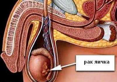Диагностика и лечение рака яичка