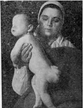 Крестцово-копчиковая тератома у ребенка.