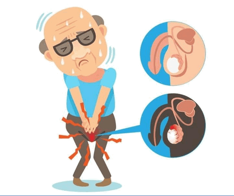 Опухоль яичка