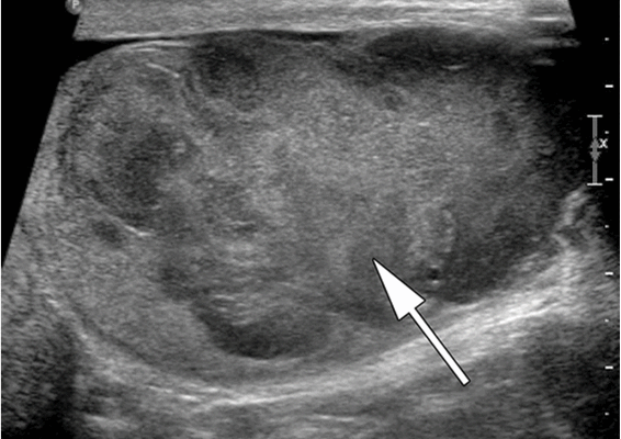 Снимок УЗИ яичка