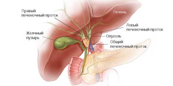 Опухоль Клацкина