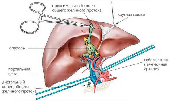 Расширенная резекция печени при опухоли Клацкина