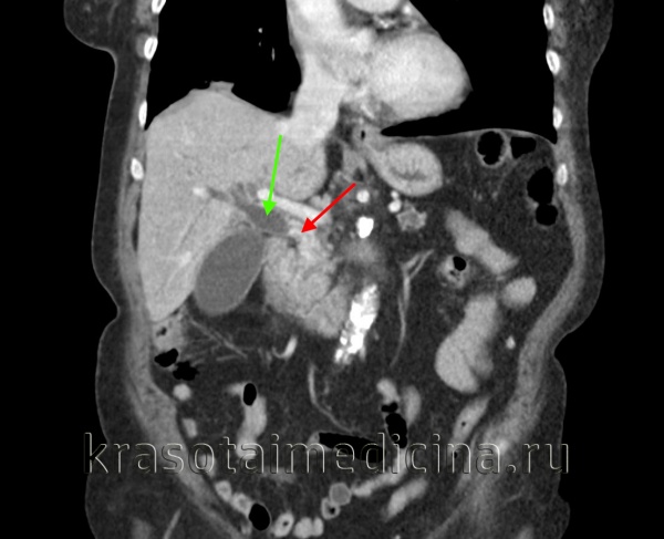 Рак внепеченочных желчных путей