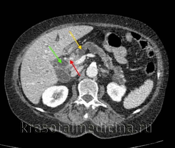 Рак внепеченочных желчных путей