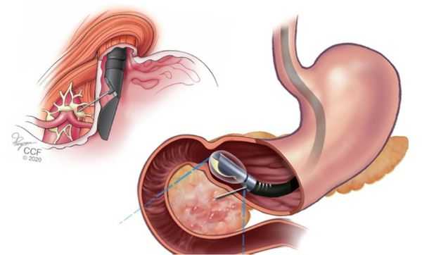 Эндоскопическое УЗИ