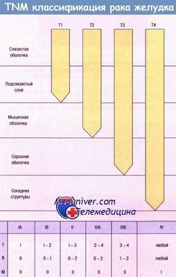 Классификация рака желудка TNM, по стадиям