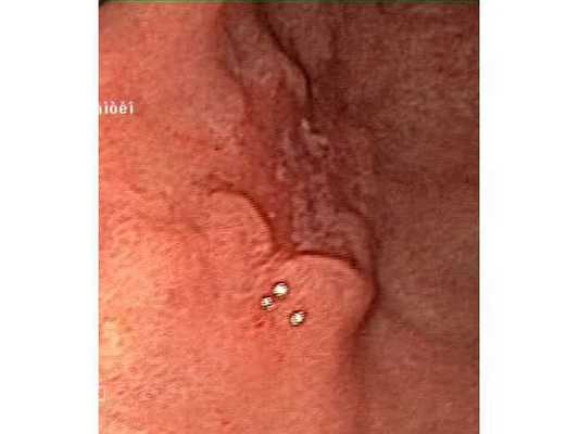 Опухоль размером 10 мм. Осмотр в белом свете