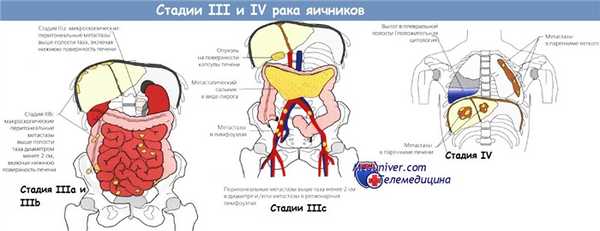Стадия III-IV рака яичников