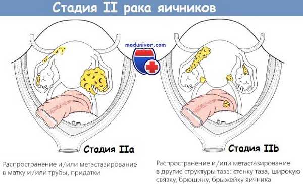 Стадия II рака яичников