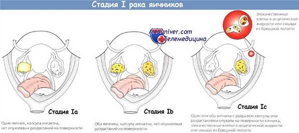Стадия I рака яичников