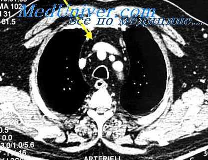 ранения грудной клетки