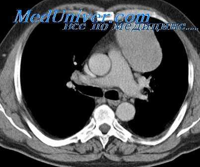 травмы средостения