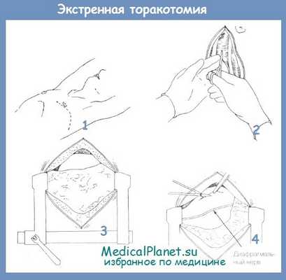 Экстренная торакотомия при проникающем ранении средостения