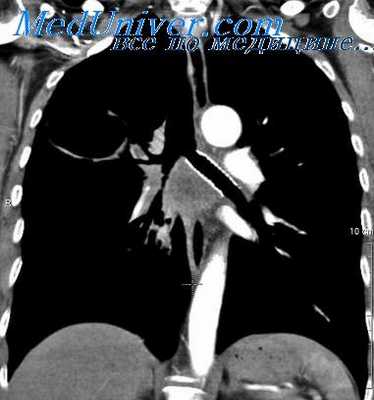 ранения средостения